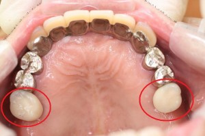 被せ物装着後の口腔内写真（上あご）