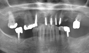 インプラント症例