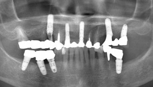 インプラント　症例